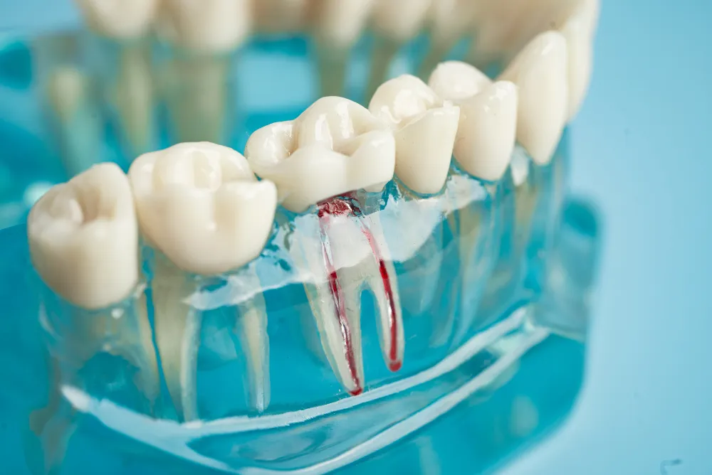 Root canal Treatment Training